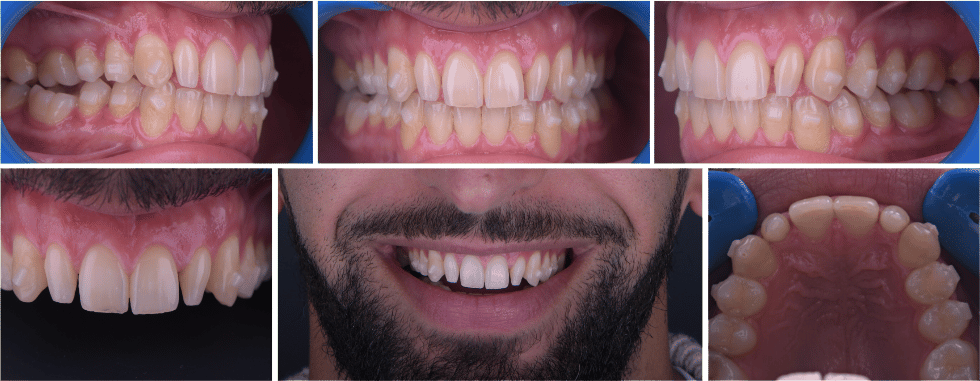 Dents Riziformes