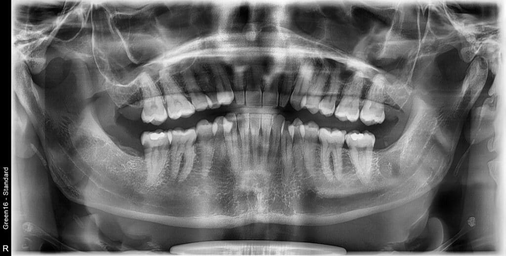 Dents riziformes