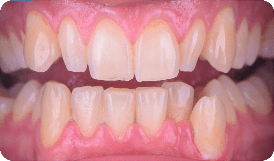 dents riziformes