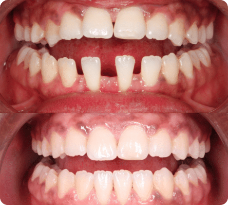 récession gingival