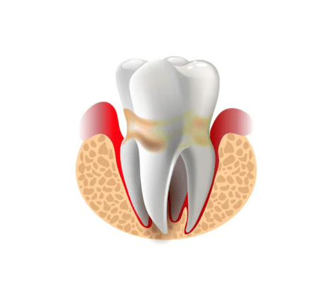 Orthodontie invisible