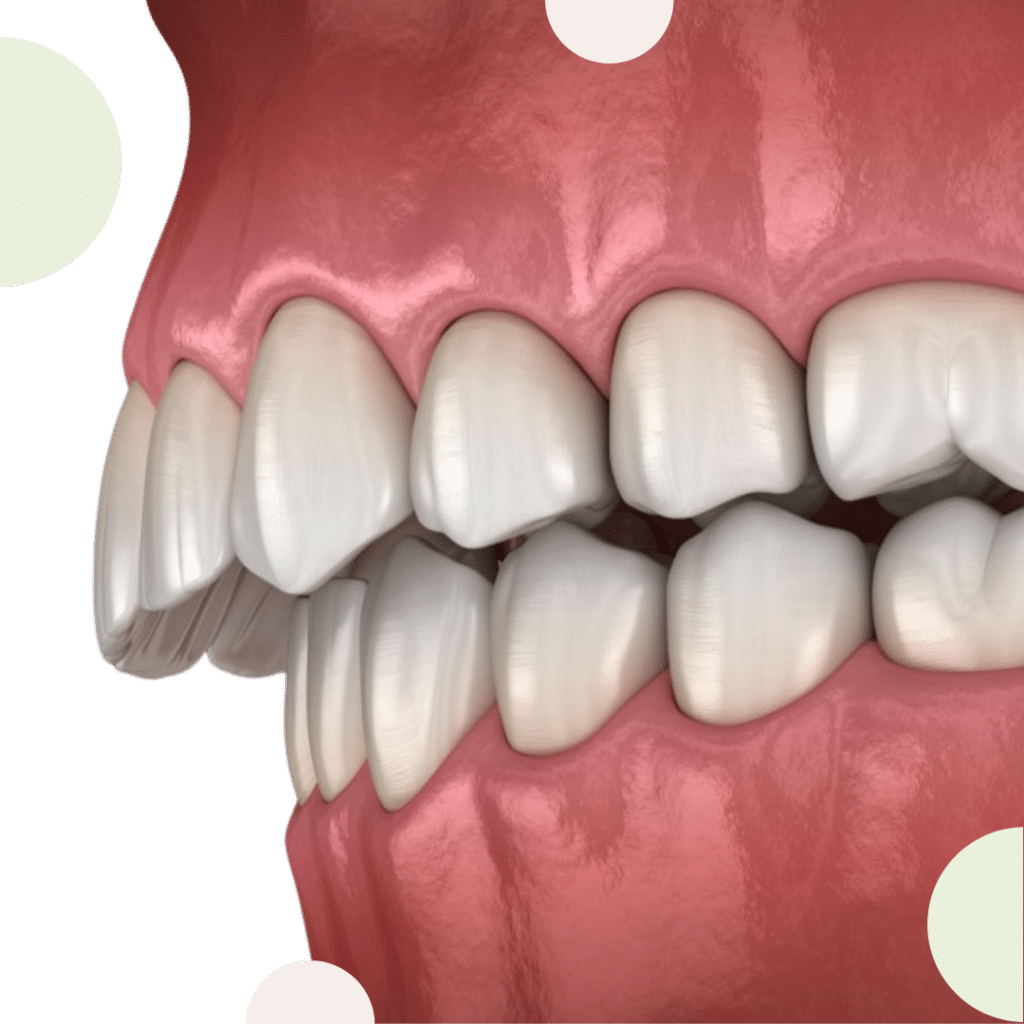 Classe II Formation en orthodontie par aligneurs réalisée par nos orthodontistes