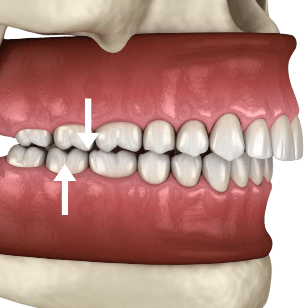 Formation dentaire réalisée par des orthodontistes : "Savoir traiter une classe II en orthodontie par aligneurs invisibles.
