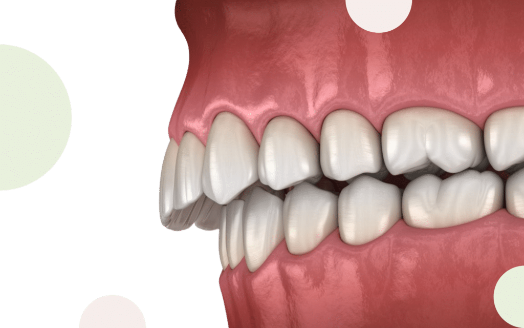 formation classe II orthodontie par aligneurs, réalisée par nos orthodontistes à distance