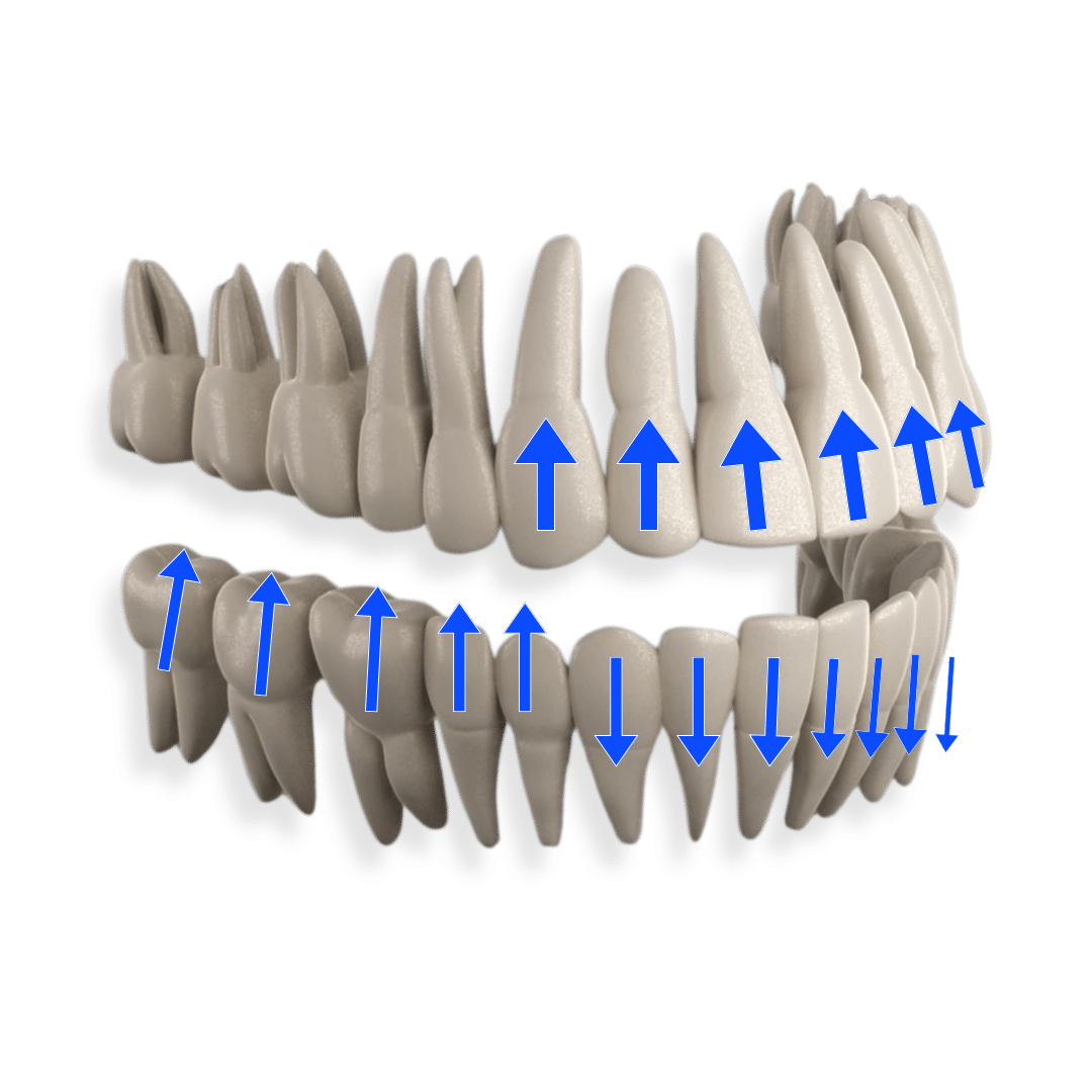 Aligneurs Français pour les orthodontistes