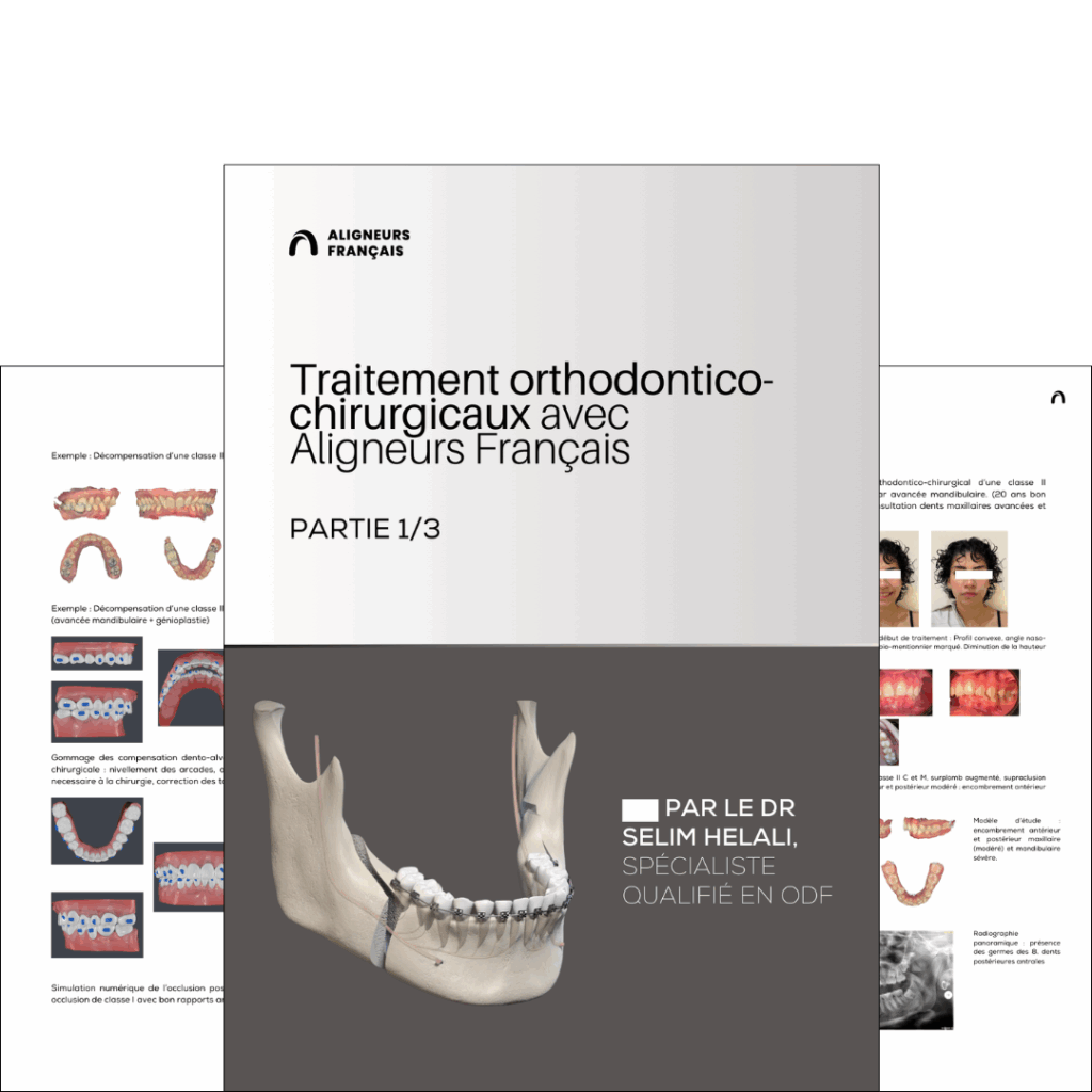 Chirurgie et orthodontie - notre guide pratique partie 1 by Aligneurs Français